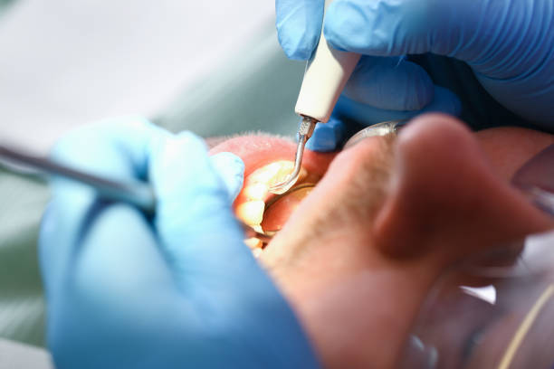 Best Emergency Tooth Extraction in Crossett, AR